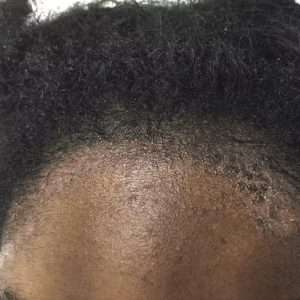Psoriasis-on-scalp